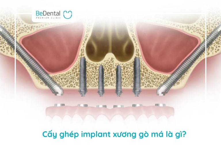 Cấy ghép implant xương gò má là cấy ghép implant vào xương hàm trên kết hợp với xương gò má của bệnh nhân để phục hồi các chức năng ăn nhai và giá trị thẩm mỹ cho hàm răng