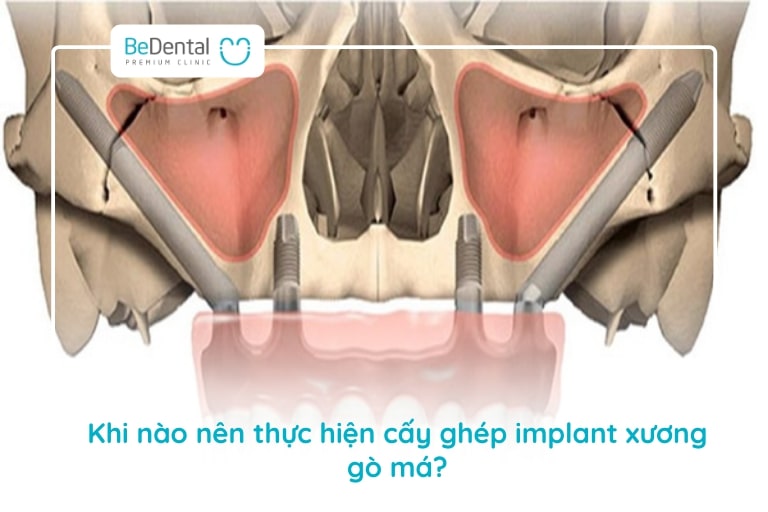 Cấy ghép implant xương gò má là phương pháp phục hình cho người mất toàn bộ răng nhưng bị teo đét sống hàm vùng răng