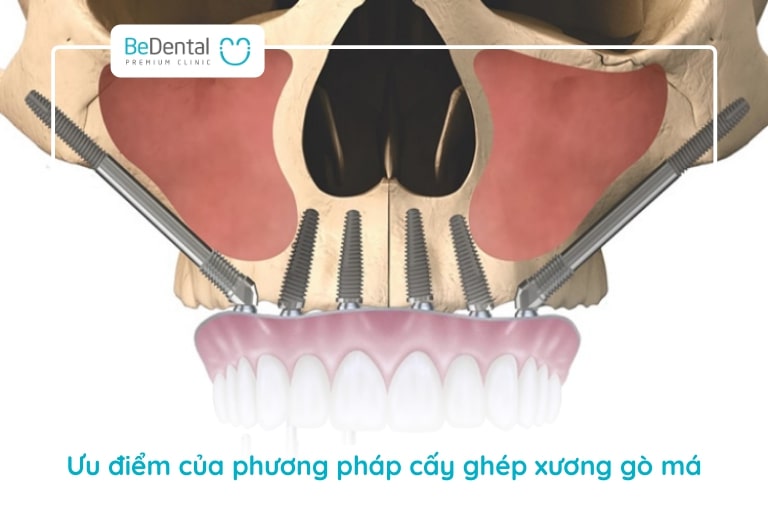 Phương pháp này giúp rút ngắn thời gian điều trị và có thể cố định răng ngay
