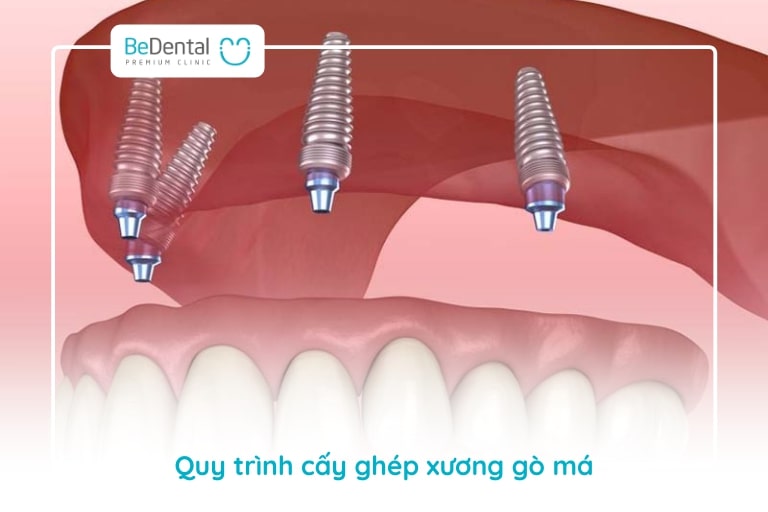 Quy trình cấy ghép phải được tính toán tỉ mỉ góc đặt trụ implant, sau đó mới tiến hành phục hình răng sứ