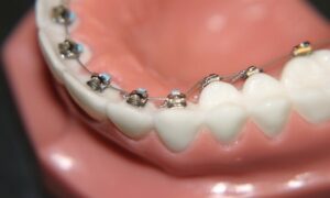 Lingual braces