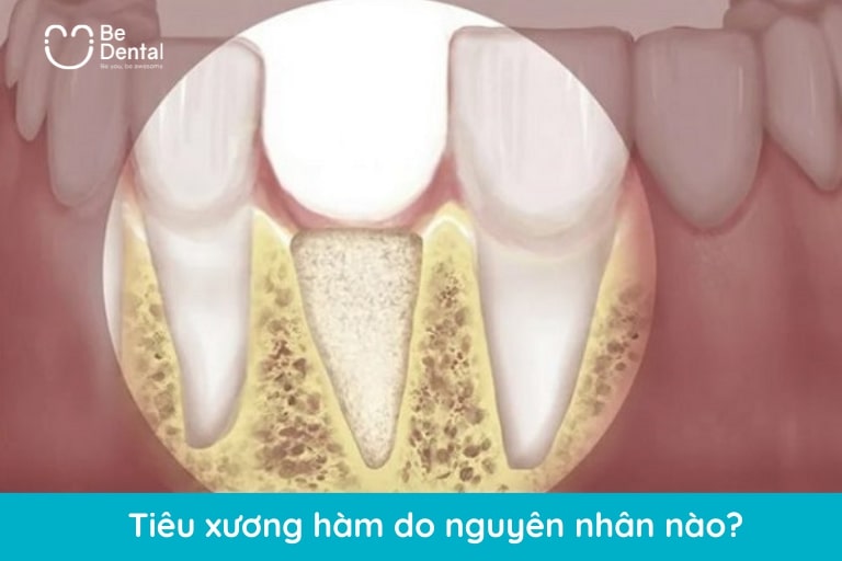 Tiêu xương hàm là do mất răng hoặc viêm nha chu gây ra