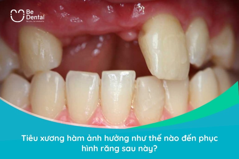 Tiêu xương hàm sẽ khiến quá trình phục hình thẩm mỹ mất răng sau này gặp nhiều khó khăn