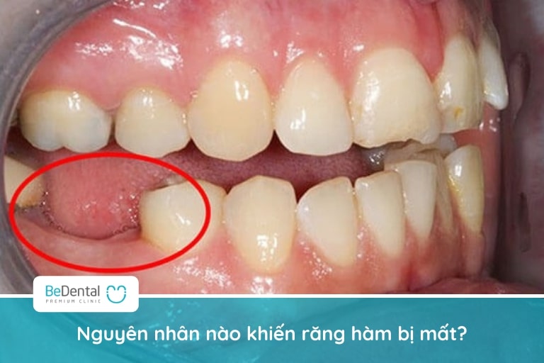 Có rất nhiều nguyên nhân làm mất răng hàm như vệ sinh răng miệng không chuẩn, bị sang chấn khớp cắn,...
