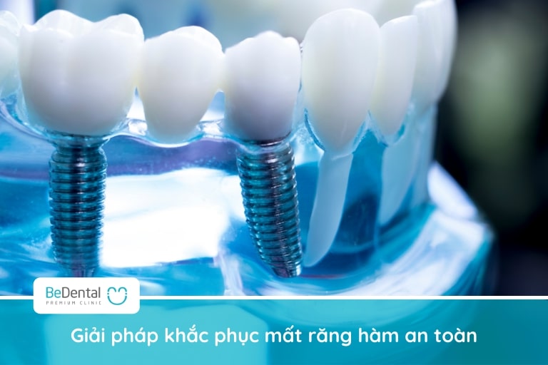 Bạn có thể dùng hàm tháo lắp, bắc cầu răng sứ hoặc trồng implant để phục hình răng hàm bị mất