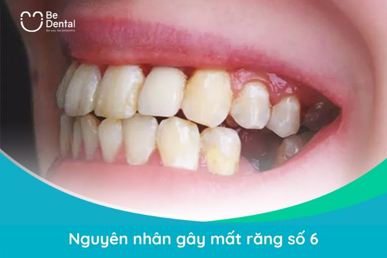 Có rất nhiều nguyên nhân gây mất răng 6 bao gồm: viêm quanh răng, vỡ nứt thân răng,...