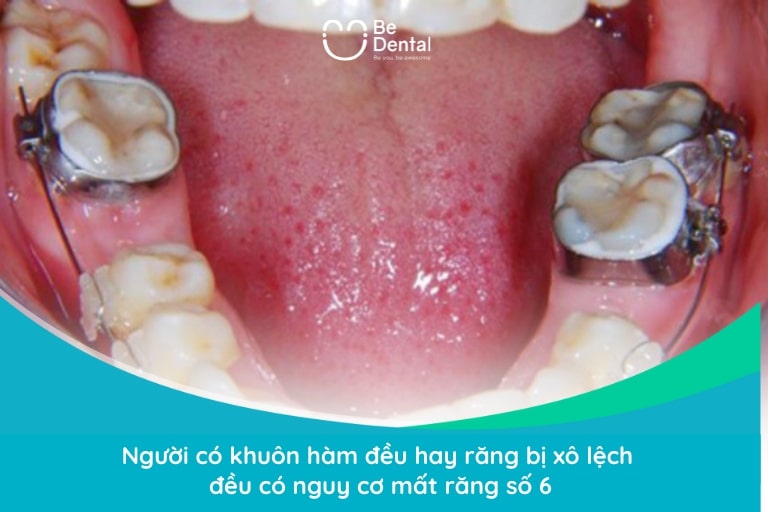 Người có khuôn hàm đều hay bị xô lệch đều có khả năng mất răng hàm 6
