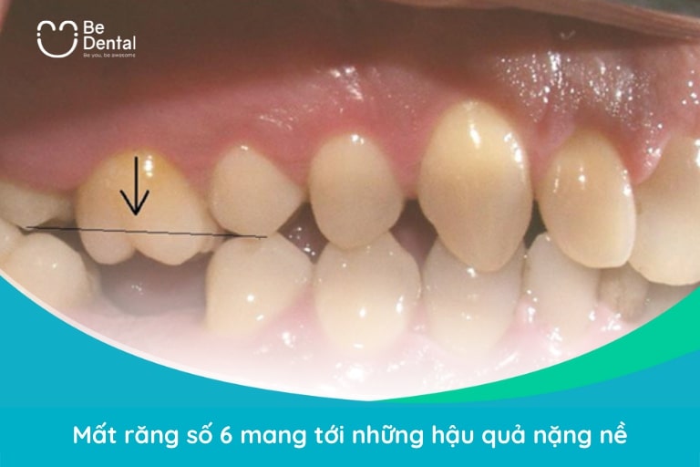 Mất răng cối số 6 mang tới nhiều hậu quả nghiêm trọng tới sức khỏe răng miệng lẫn sức khỏe tổng thể