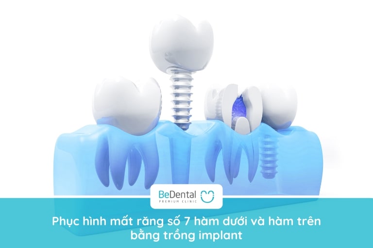 Trồng implant để phục hình mất răng hàm số 7