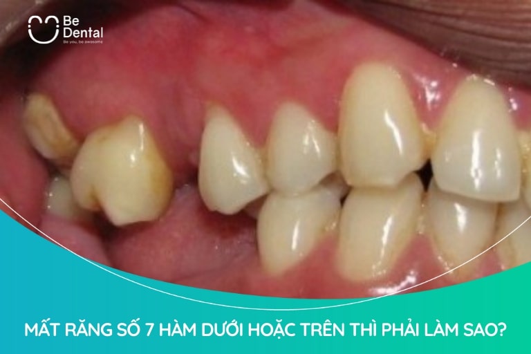 Mất Răng Số 7 Hàm Dưới Hoặc Trên Thì Phải Làm Sao?