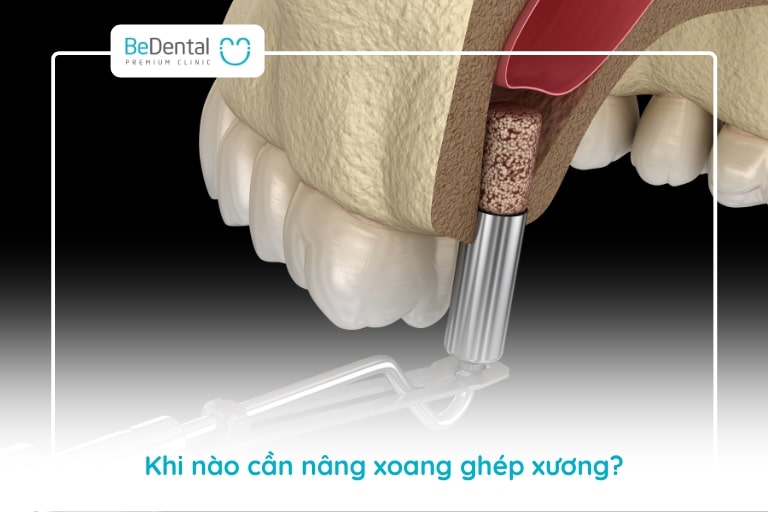 Xương hàm bị tiêu nặng và xoang hàm bị thoái hóa nên tiến hành cấy xương nâng xoang