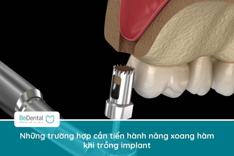 Những người bị tiêu xương hàm, mất răng lâu năm khiến xoang hàm bị thoái hóa cần nâng xoang khi trồng implant
