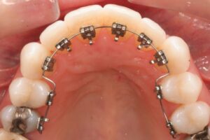 Lingual braces's advantages