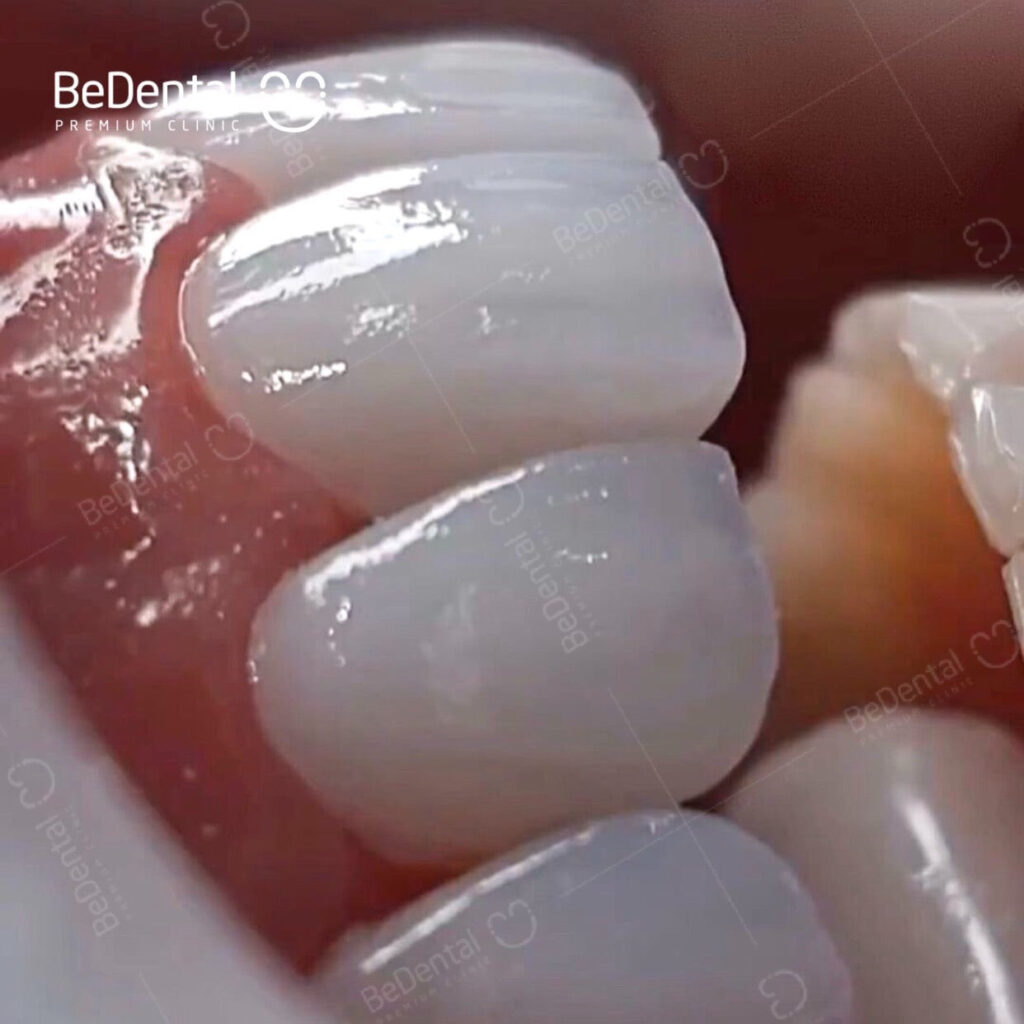 Răng vĩnh viễn: Cấu tạo, chức năng và quy trình phục hình chuyên sâu 5 Phân biệt răng sữa và răng vĩnh viễn