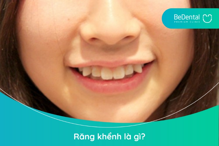 Răng khểnh là chiếc răng số 3 bị mọc sai lệch theo một cung độ và kiến tạo vẻ đẹp duyên dáng cho nụ cười