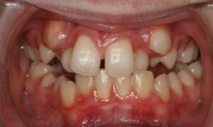 trường hợp nào nên nhổ bỏ răng nanh
