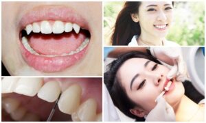 cách làm răng nanh tại nha khoa