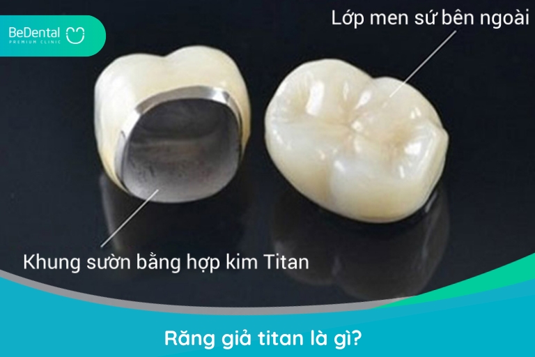 Răng sứ titan là loại răng sứ có cấu tạo 2 phần: phần lõi kim loại bên trong và bên ngoài phủ lớp sứ nguyên chất