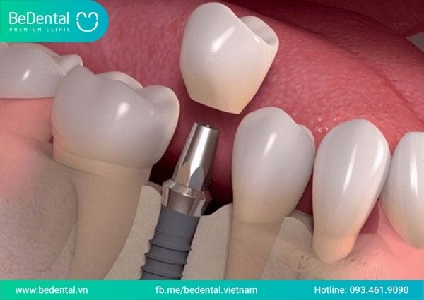 Trồng răng Implant Dentium Hàn Quốc