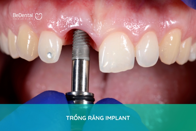 răng implant