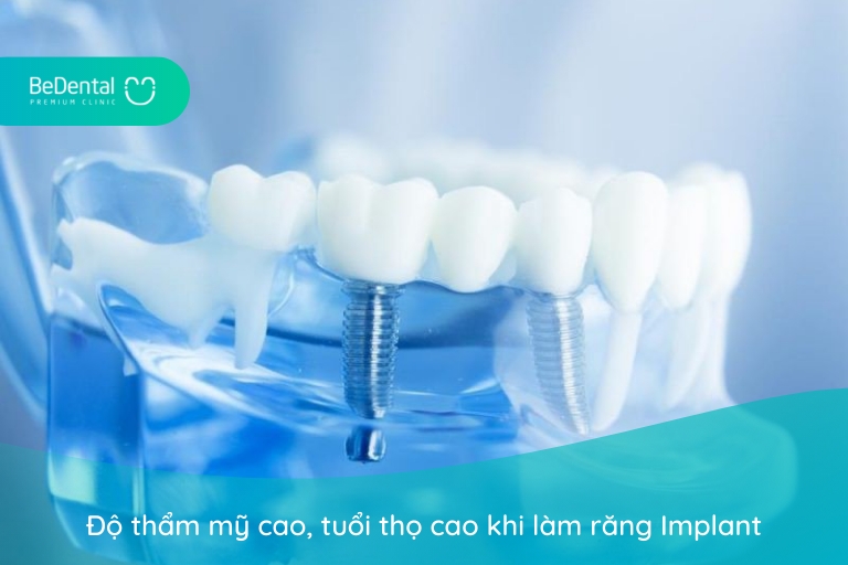 ưu điểm răng implant