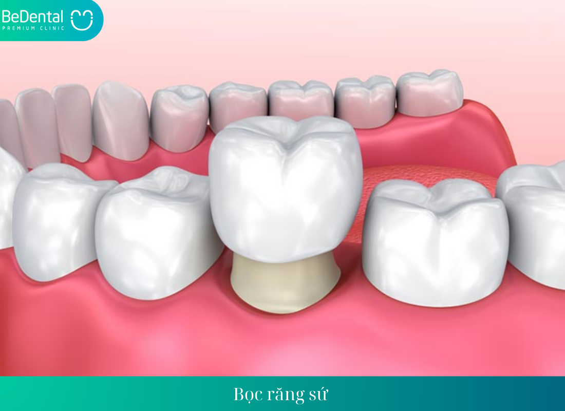 Bọc răng sứ là gì? 