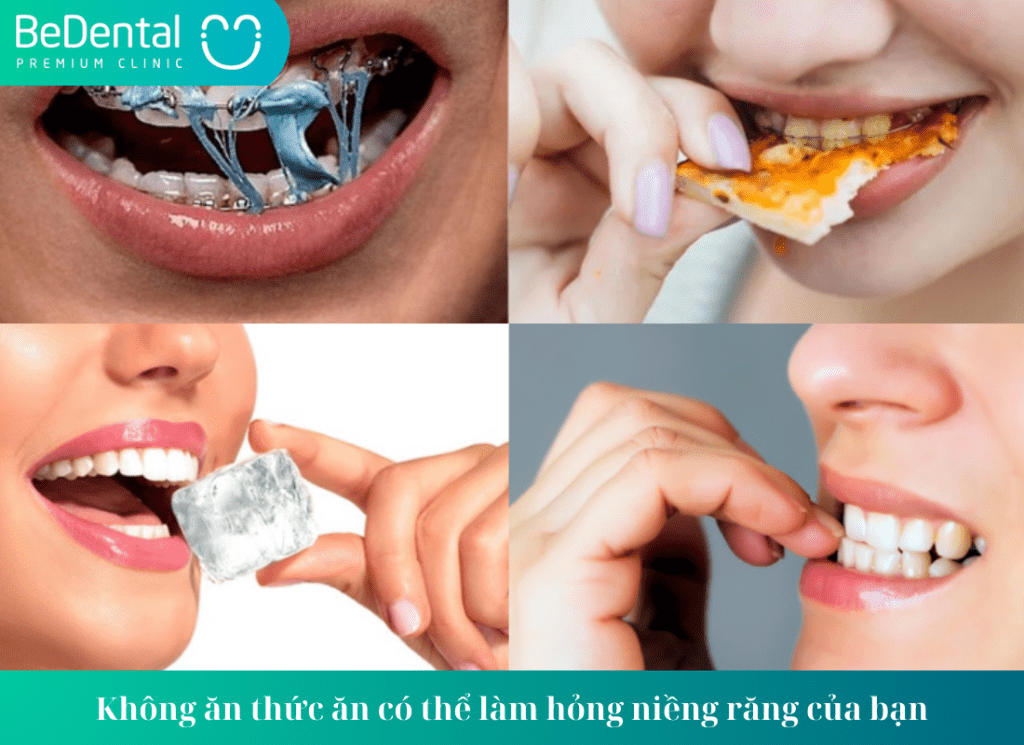 Không ăn thức ăn có thể làm hỏng niềng răng của bạn