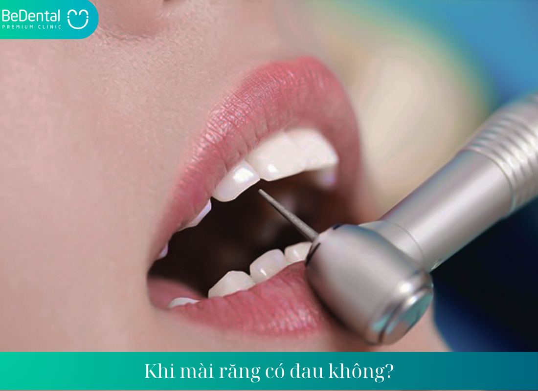 Mài răng có đau không?