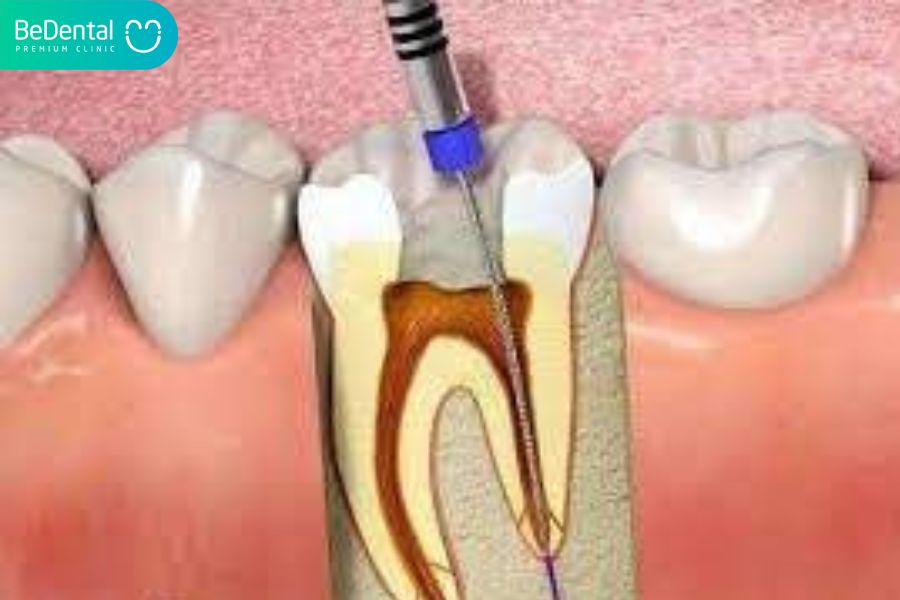 Lấy tủy răng là như thế nào