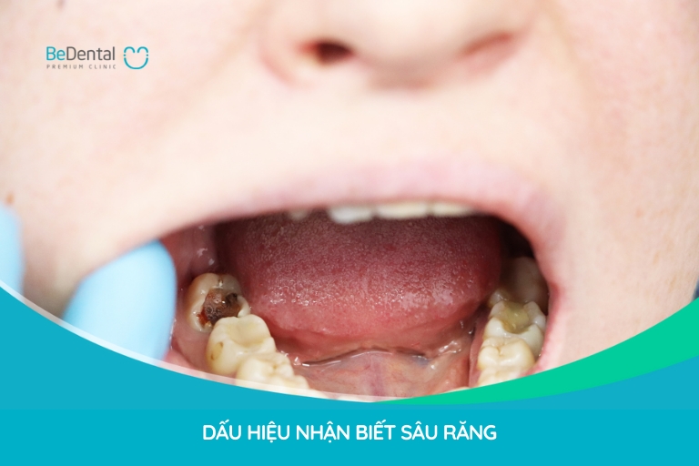 Bạn có thể nhận biết sâu răng qua các dấu hiệu như: lỗ sâu trên răng, nướu sưng đau, chảy máu nướu, miệng có mùi hôi,...