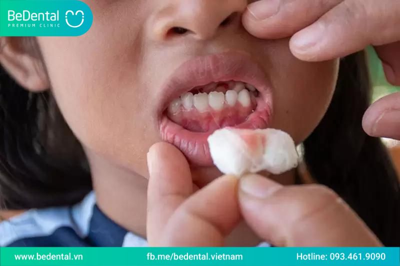 các tai nạn thường gặp vùng răng hàm mặt