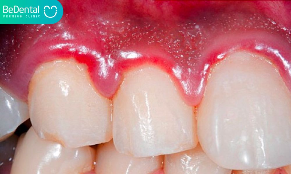 Cách hết đau răng cấm hiệu quả, an toàn