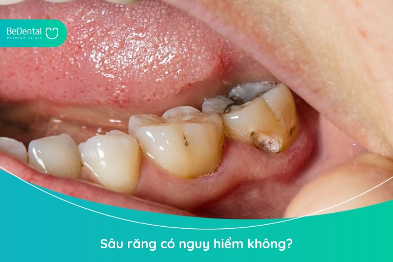 Sâu răng là bệnh lý răng miệng tuy phổ biến nhưng tiềm ẩn nhiều biến chứng nguy hiểm