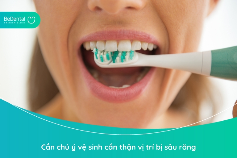 Để ngăn sâu răng phát triển, bạn cần chú trọng vệ sinh vị trí răng sâu