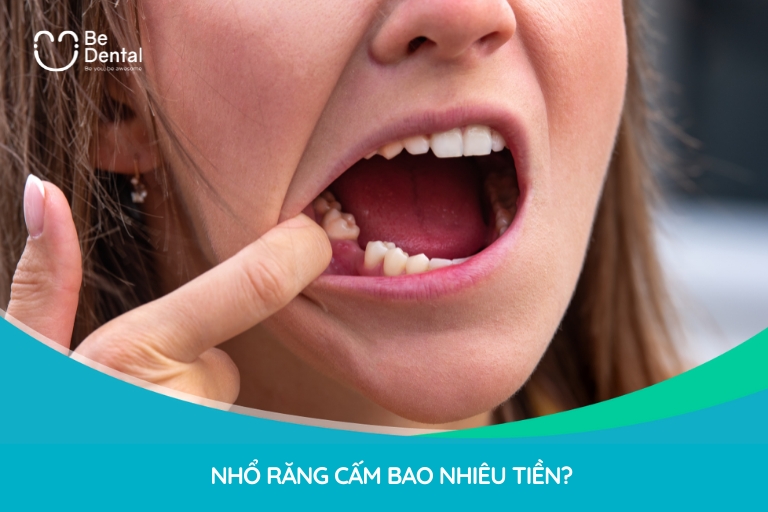 Chi phí nhổ răng dao động từ 800.000 - 3.500.000 VNĐ