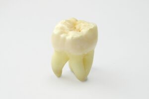 răng cấm bị lung lay phải làm sao