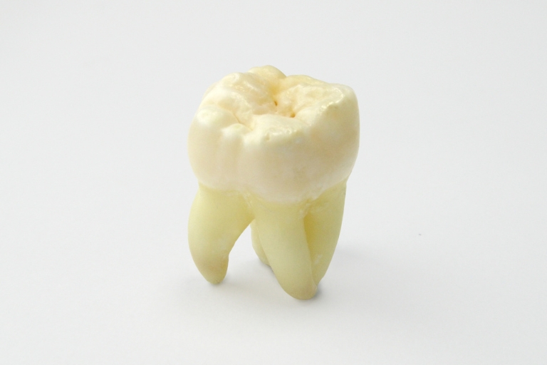 Răng cấm bị lung lay có nên nhổ không?