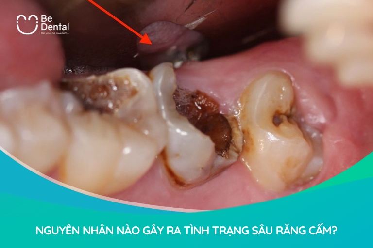Có rất nhiều nguyên nhân dẫn tới tình trạng răng cấm bị sâu