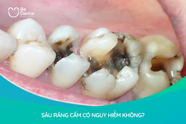 Bị sâu răng cấm sẽ ảnh hưởng nghiêm trọng tới sức khỏe răng miệng lẫn sức khỏe tổng thể