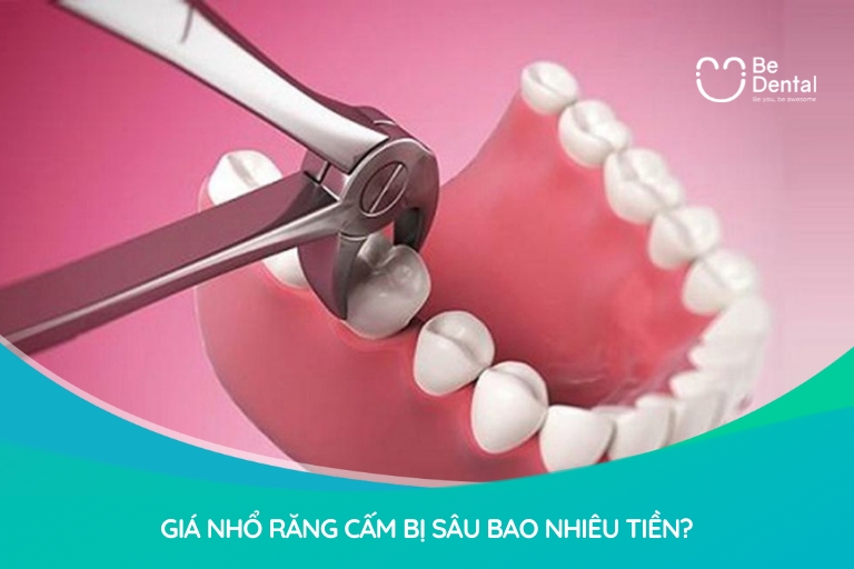Giá nhổ răng cấm bị sâu dao động từ 800.000 - 3.500.000/răng