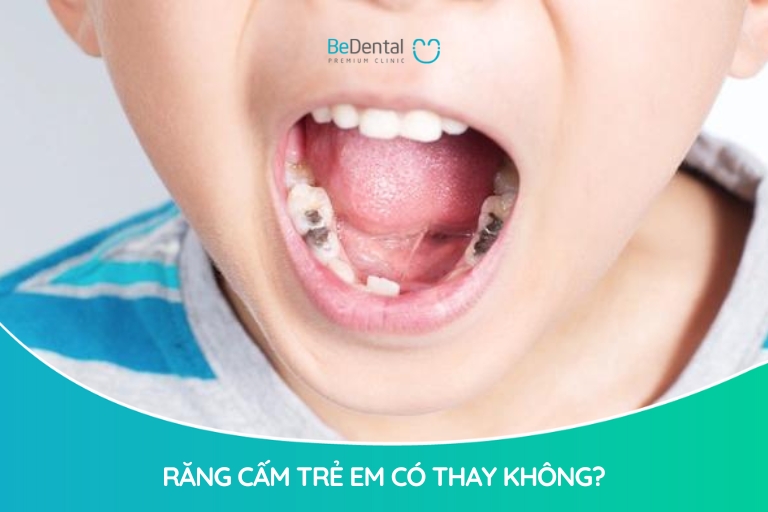 Răng cấm trẻ em có thay không? Răng cấm là răng vĩnh viễn nên không có khả năng thay và mọc mới