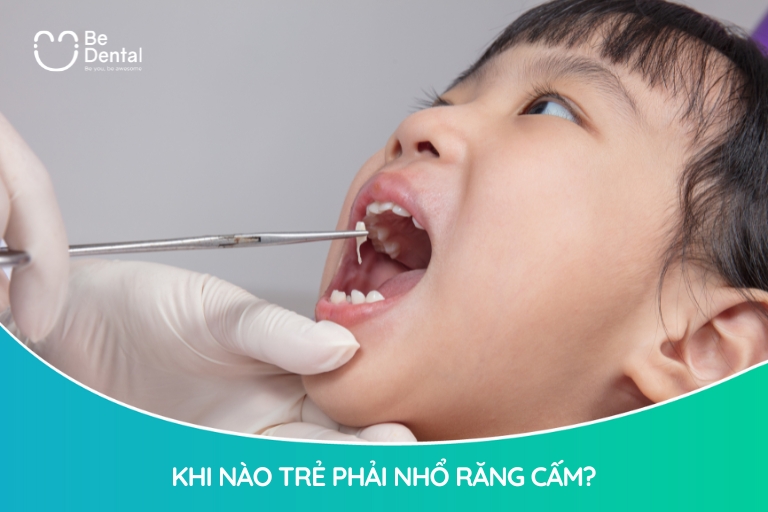 Trẻ cần nhổ răng cấm khi bị sâu nặng, chấn thương nghiêm trọng không thể phục hình thẩm mỹ,...