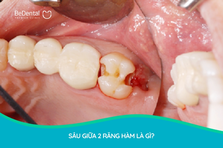 Sâu giữa 2 răng hàm là sâu răng tấn công vào giữa các kẽ răng, sau đó lan rộng ra toàn răng