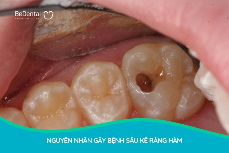 Có rất nhiều nguyên nhân gây ra tình trạng sâu giữa 2 răng hàm như chế độ chăm sóc răng miệng, ăn uống, thói quen dùng tăm tre,...