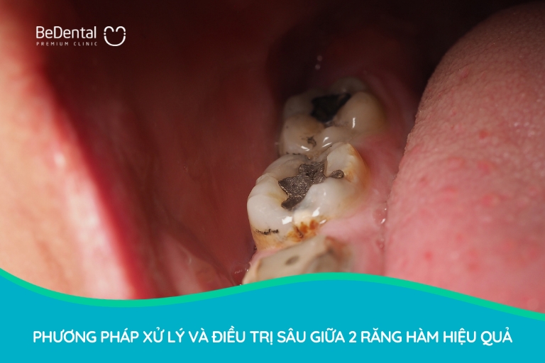 Tùy từng mức độ sâu răng, bác sĩ sẽ chỉ định hàn trám, bọc sứ hoặc nhổ bỏ để loại trừ ổ sâu tận gốc