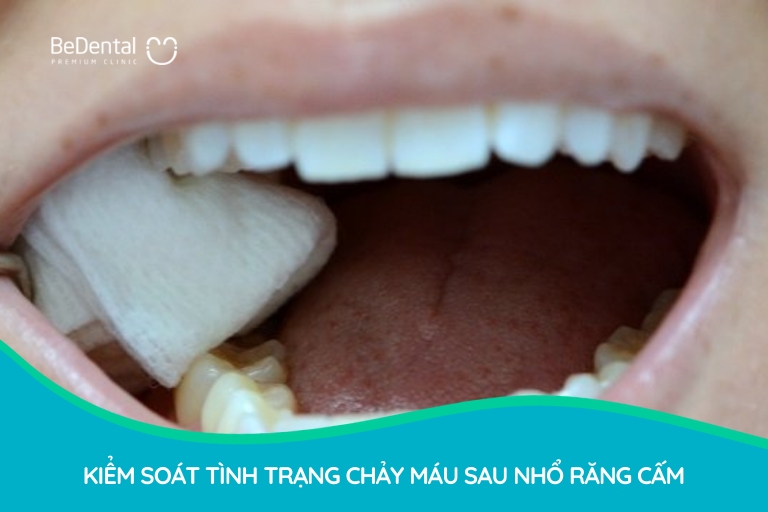 Bạn cần kiểm soát tốt hiện tượng chảy máu sau nhổ răng cấm