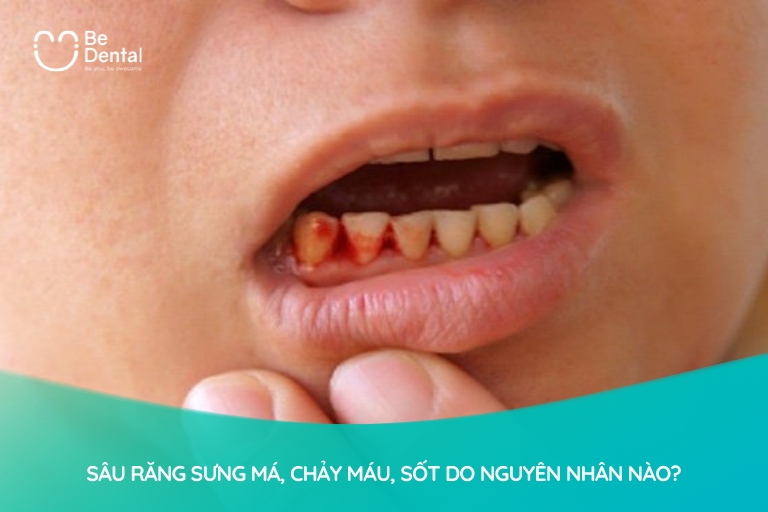 Có rất nhiều nguyên nhân khiến sâu răng sưng má, chảy máu hoặc sốt như: vệ sinh răng miệng không đúng, viêm nướu, sâu lan rộng, áp xe răng,...