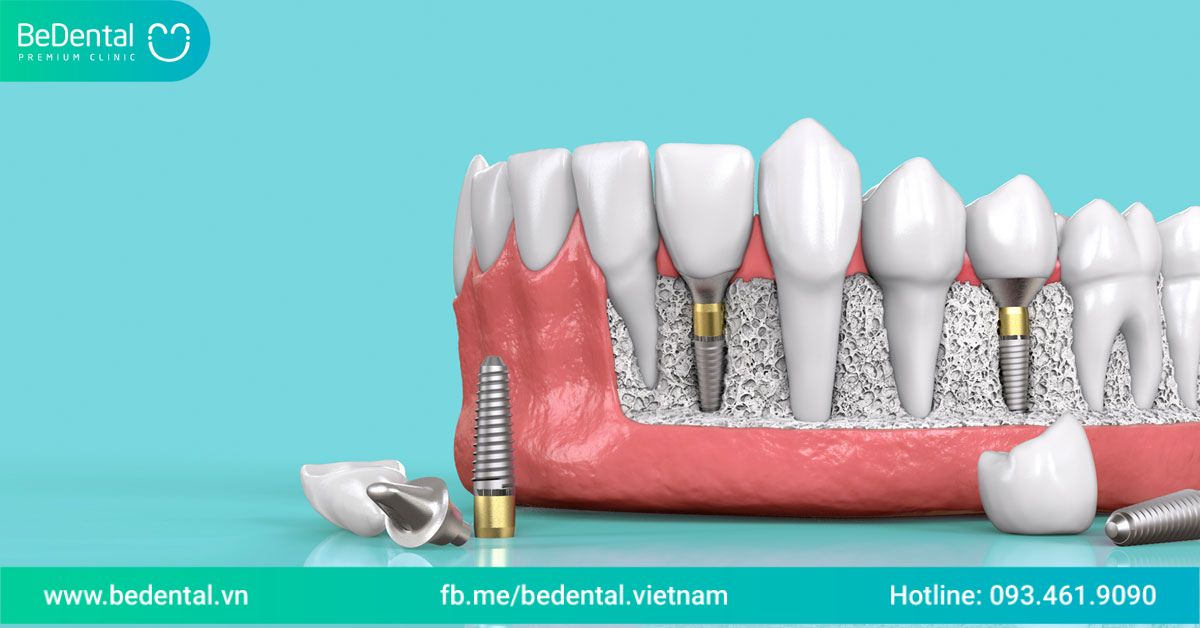 Trồng implant là gì?Trồng răng implant có được bảo hiểm không?