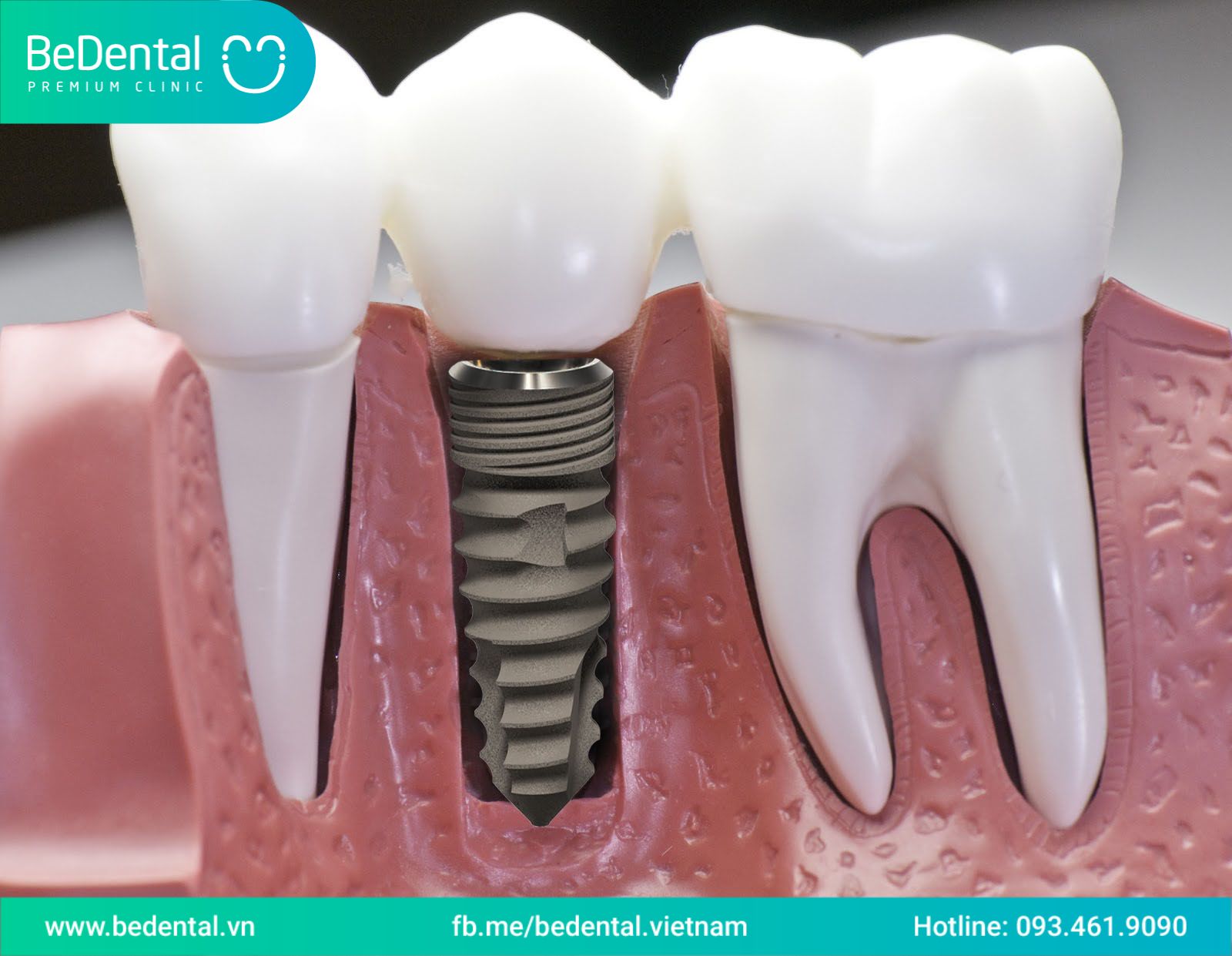 trồng implant là gì