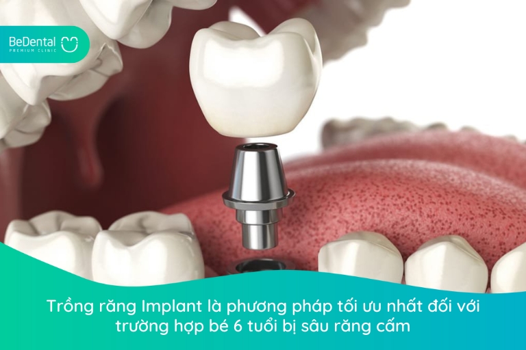 trồng răng Implant cho bé 6 tuổi bị sâu răng cấm